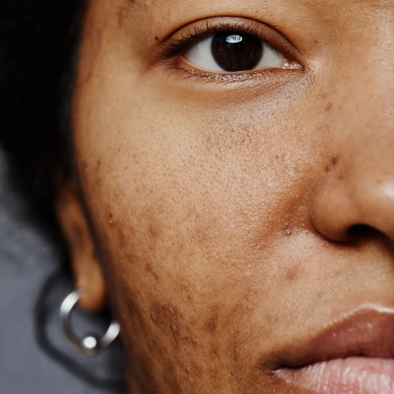 Hyperpigmentation